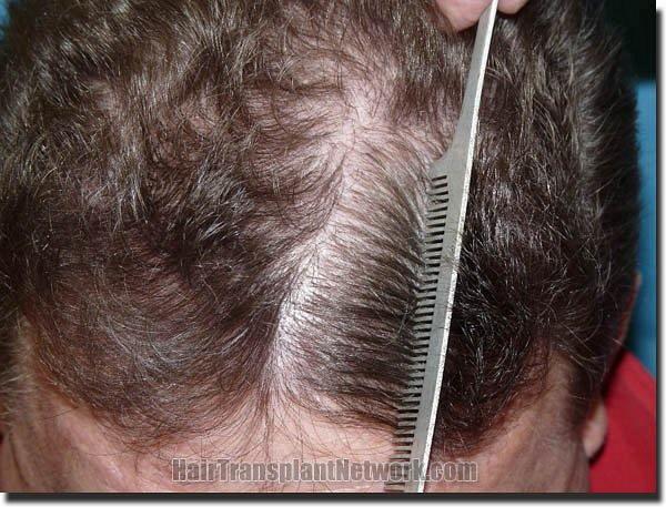 Hair restoration procedure results