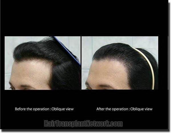 Hair restoration procedure results