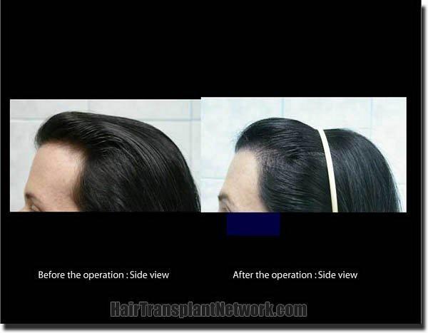 Hair restoration procedure results