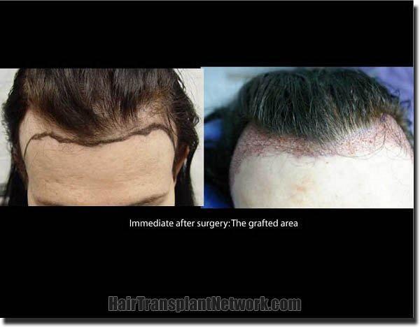 Hair restoration procedure results