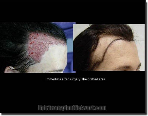 Hair restoration procedure results