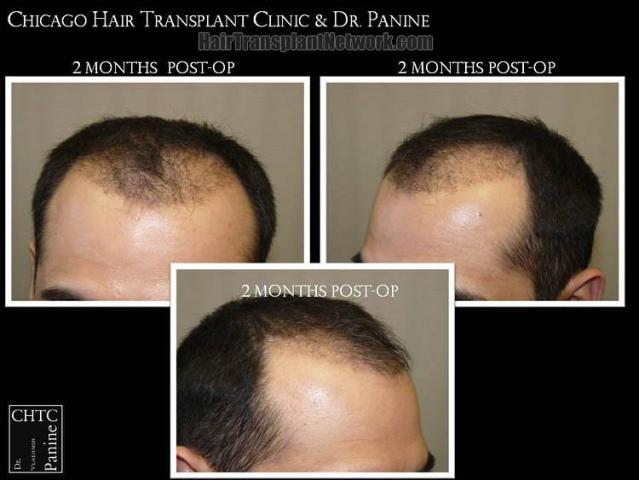 Hair restoration surgery before and after photos