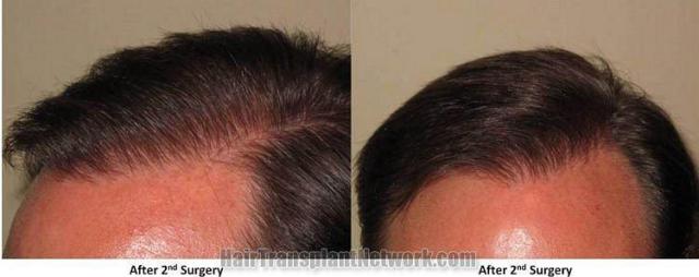 Closeup views of hairlines after hair restoration