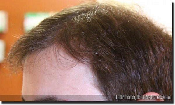 Hair restoration procedure results