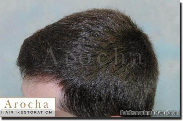 Hair restoration procedure results