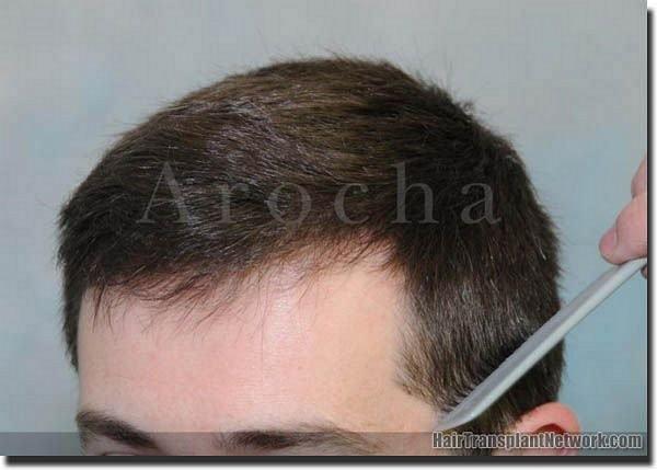 Hair restoration procedure results