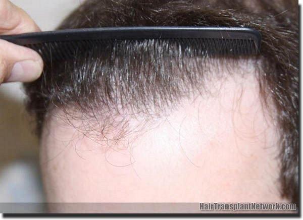 Hair restoration procedure results