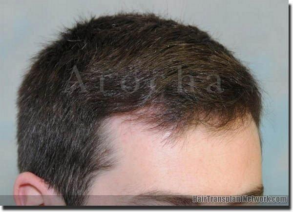 Hair restoration procedure results