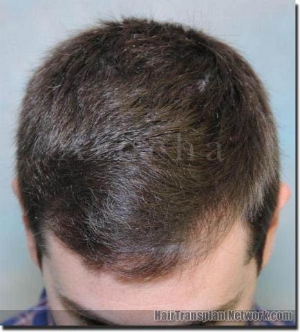 Hair restoration procedure results