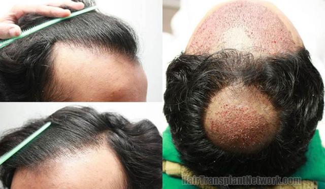 Hair restoration surgery before and after photos