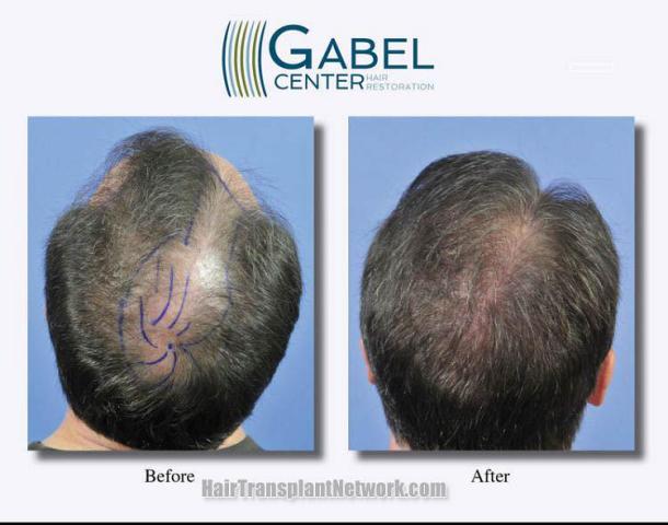 Hair restoration procedure before and after pictures