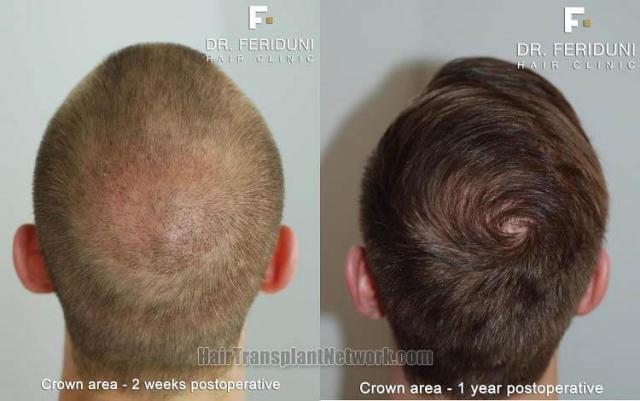 Hair restoration procedure before and after pictures,