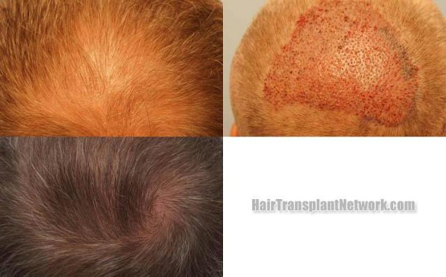 Hair transplantation surgery before and after images