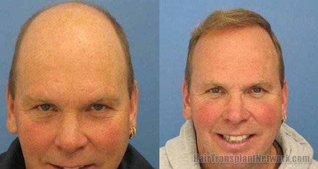 Hair restoration results 4365 grafts