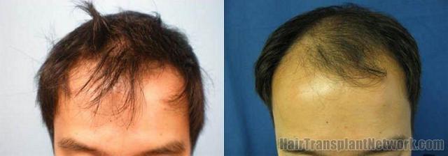 Hair transplant results 1742 grafts after 10 months