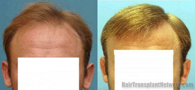 2416 graft front view before and after hair transplant