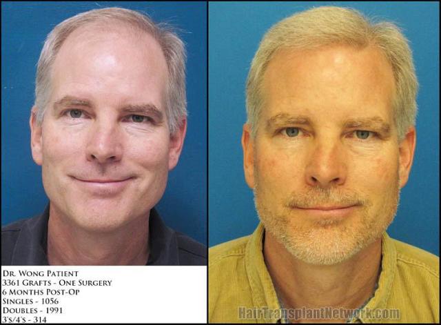 Hair restoration procedure before and after results