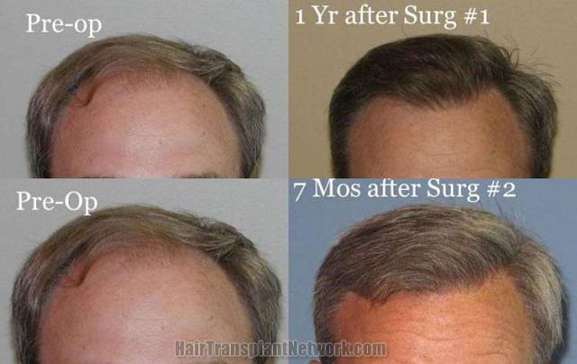 Before and after hair transplant procedure images