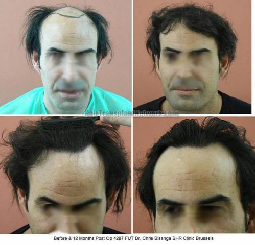 Hair transplantation surgery before and after photos