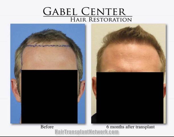 Hair restoration procedure before and after results