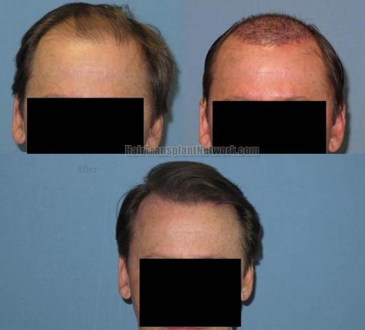 Hair restoration procedure before and after results