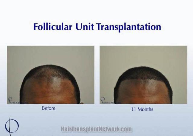 Hair restoration procedure before and after results