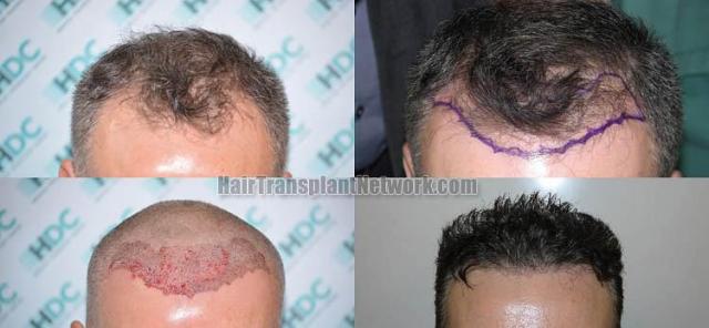 Hair restoration procedure before and after results