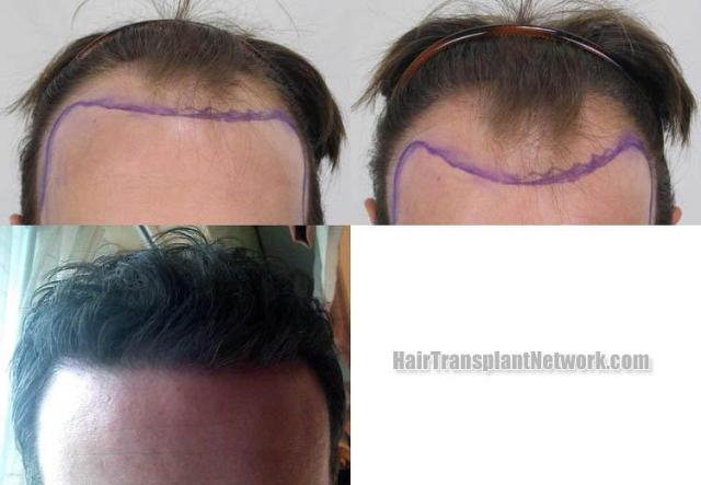 Hair transplantation surgery before and after images