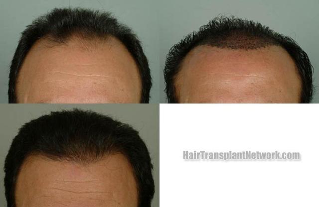 Hair restoration procedure before and after results