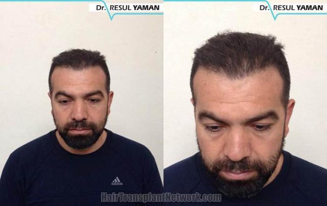 Before and after hair transplant procedure images