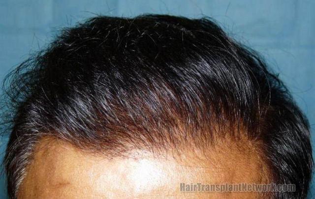 Front closeup view after hair transplant