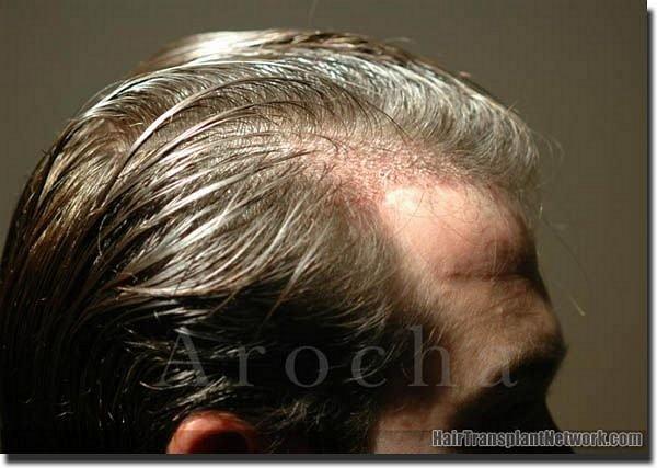 Hair restoration procedure results