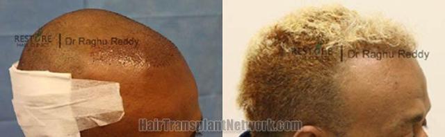 Hair transplantation surgery before and after images