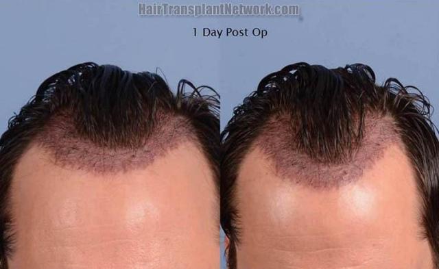 Hair restoration procedure before and after pictures