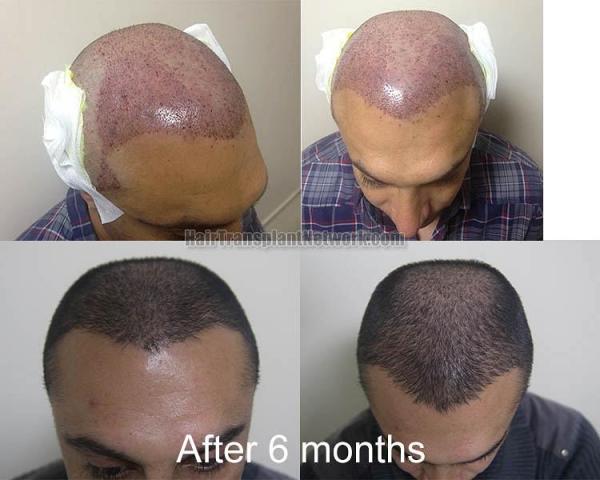 Hair restoration procedure before and after pictures