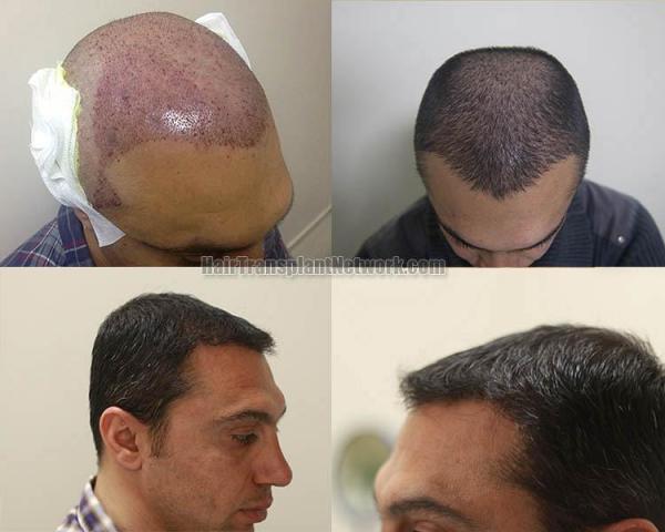 Hair restoration procedure before and after result photographs