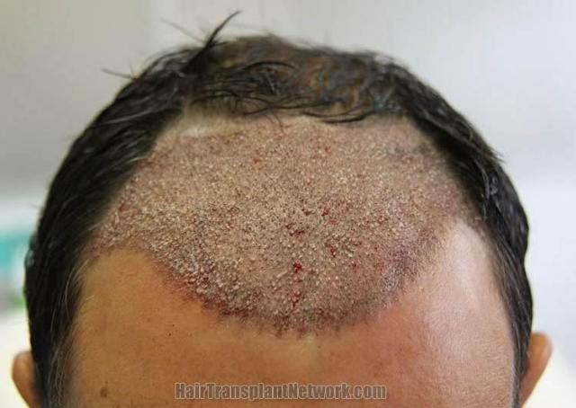 Hair restoration surgery before and after images