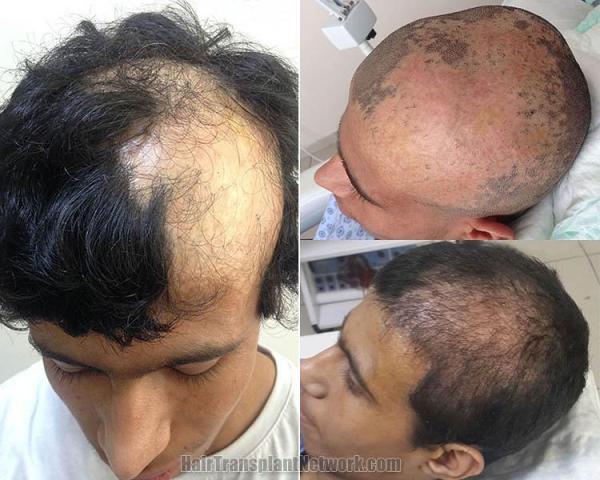 Hair transplantation surgery before and after images