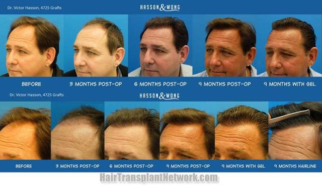 Hair transplant surgery before and after photos