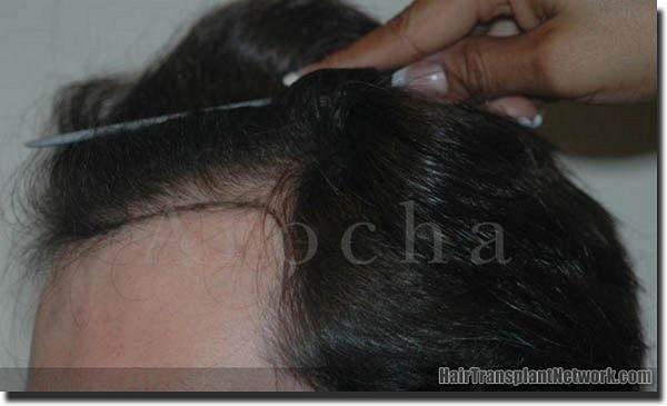 Hair restoration procedure results