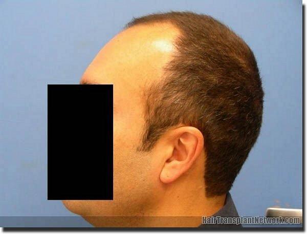 Hair restoration procedure results