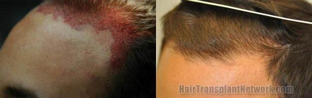 Hair restoration photos before and postoperative