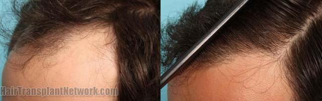 Hair restoration procedure before and after pictures