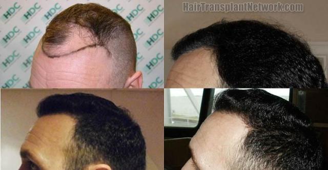 Hair restoration procedure before and after pictures