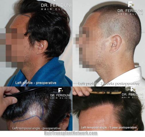 Hair transplantation surgery before and after pictures