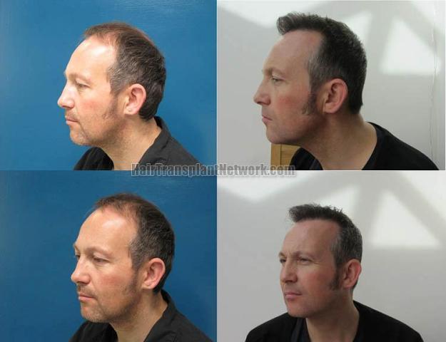 Hair transplantation surgery before and after pictures