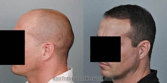 Hair transplantation surgery before and after pictures