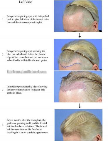 Hair transplantation surgery before and after pictures