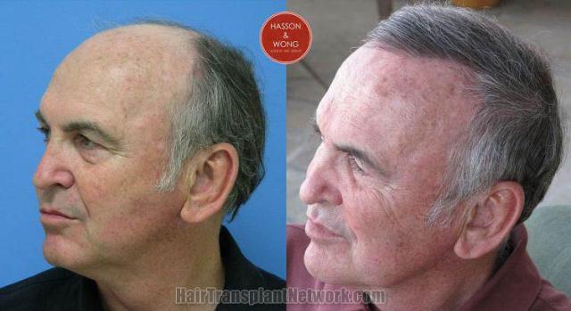 Hair transplantation surgery before and after pictures