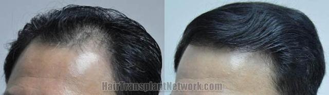 Hair transplantation surgery before and after pictures